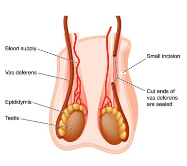 Vasectomy by OrangeCountySurgeons  (2)